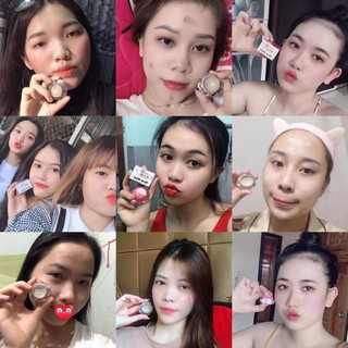 KEM MỤN ĐÔNG Y HOA ĐÀO