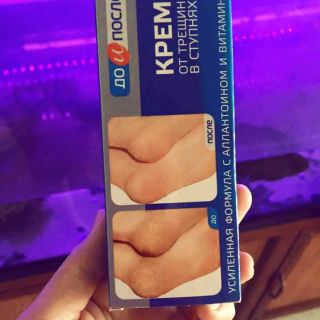 KEM TRỊ NỨT GÓT CHÂN KPEM