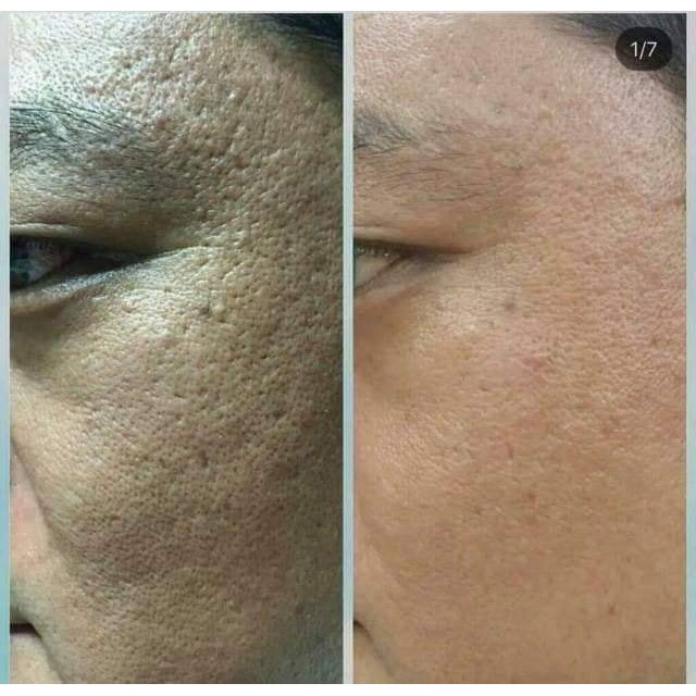 Vi Kim Sinh Học Tái Tạo Da Venus Peel Powder 0.7g ,Venus Peel Serum 5mlx 2 gói, tuyển sỉ, CTV IB | BigBuy360 - bigbuy360.vn