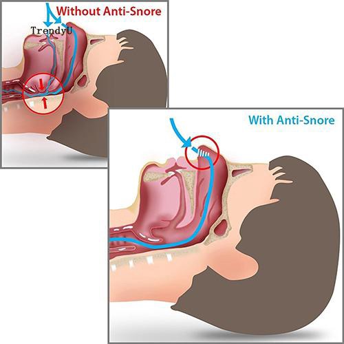 Dụng cụ gắn mũi chống ngáy khi ngủ tiện lợi