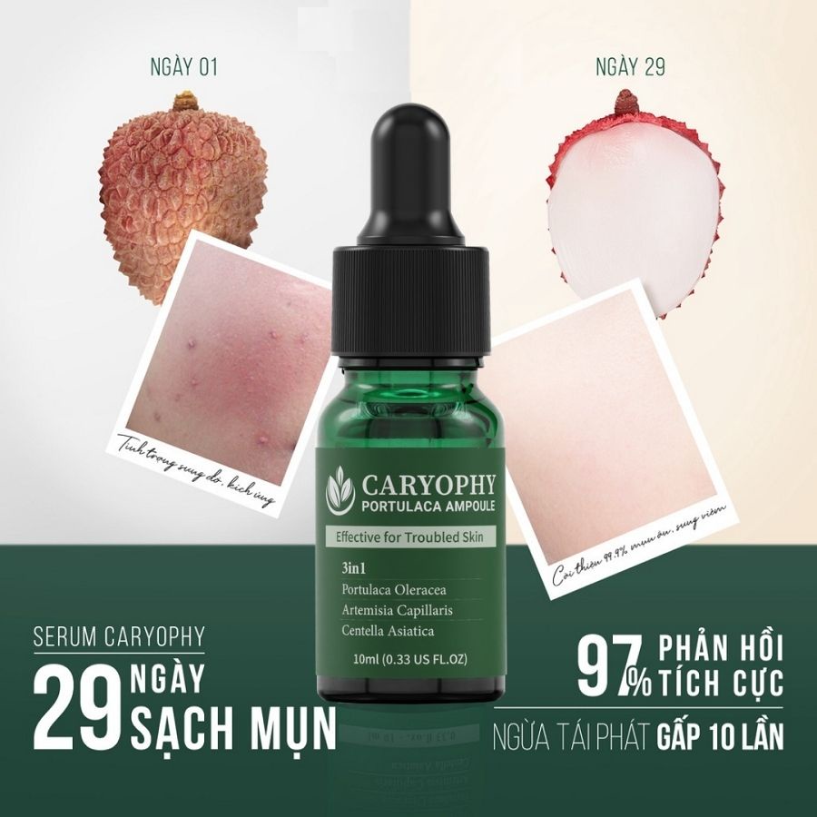 Bộ dưỡng da giảm mụn mờ thâm Caryophy Portulaca (xịt mụn lưng 150ml + serum 10ml) ILIVING-CARCBXMLSR10