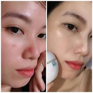 Truyền trắng mụn Mwhite (cam kết chính hãng)