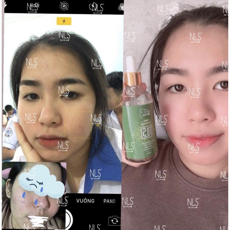 SERUM NGỌC LINH SÂM + BỘT RỬA MẶT LOẠI BỎ MỤN NÁM TÀN NHANG