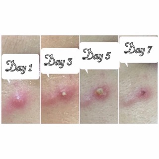 Miếng dán mụn Acne Pimple Master Patch