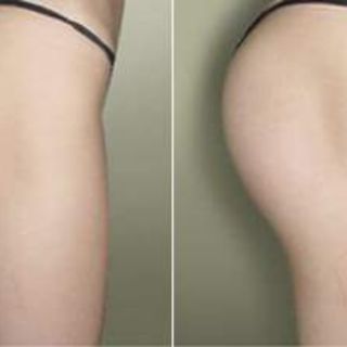 Kem nở mong Hip LIFTUP