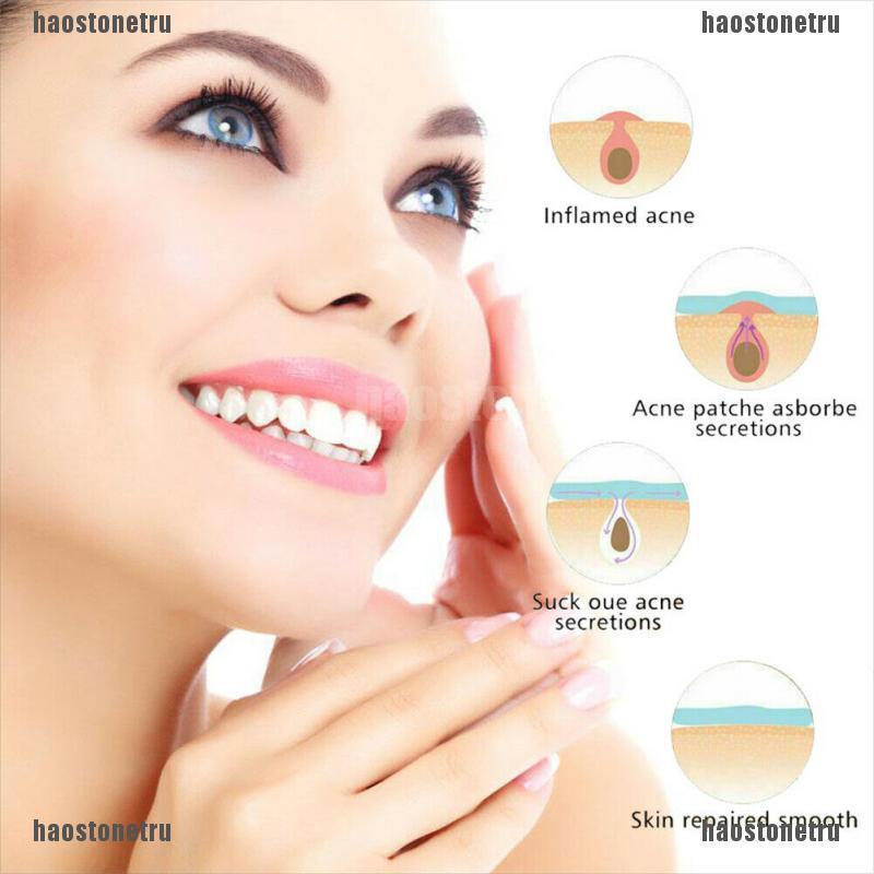 Bộ 36 Miếng Dán Mụn Hydrocolloid Và Mụn Trứng Cá