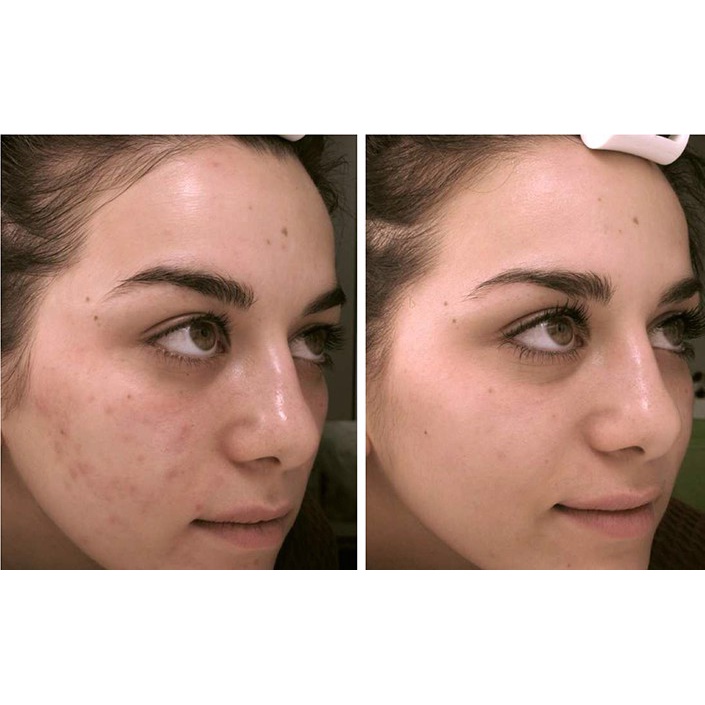 Kem Chấm Mụn Chuyên Biệt La Roche-Posay Effaclar A.I. Targeted Breakout Corrector 15ml