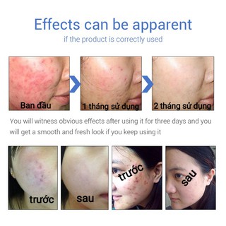 Kem Trị Mụn Thần Thánh LANBENA 20g