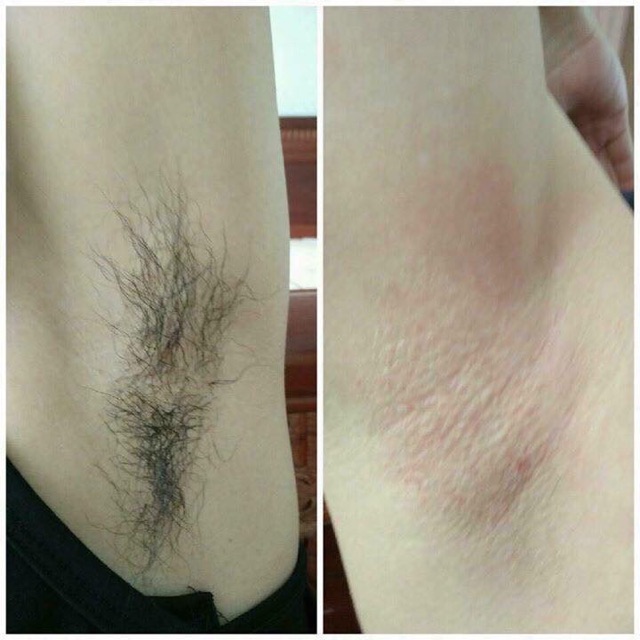 BỘ TRIỆT LÔNG VEO REMOVE - CÔNG TY NGÂN BÌNH - (có tặng kèm giấy wax và que lấy)