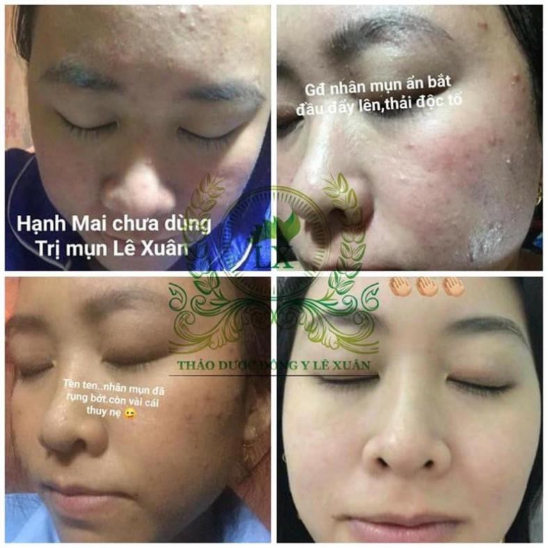 Tinh chất mụn Lê Xuân handmade 130ml | BigBuy360 - bigbuy360.vn