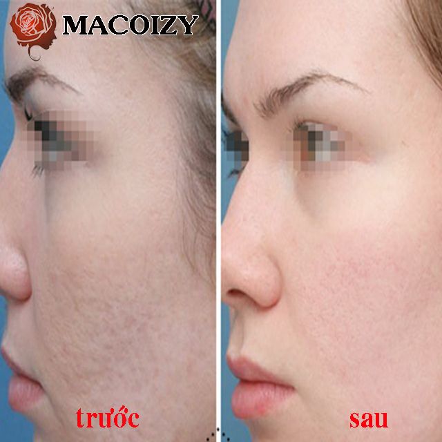 Serum Sẹo Rỗ Tái Tạo Da Se Khích Lỗ Chân Lông