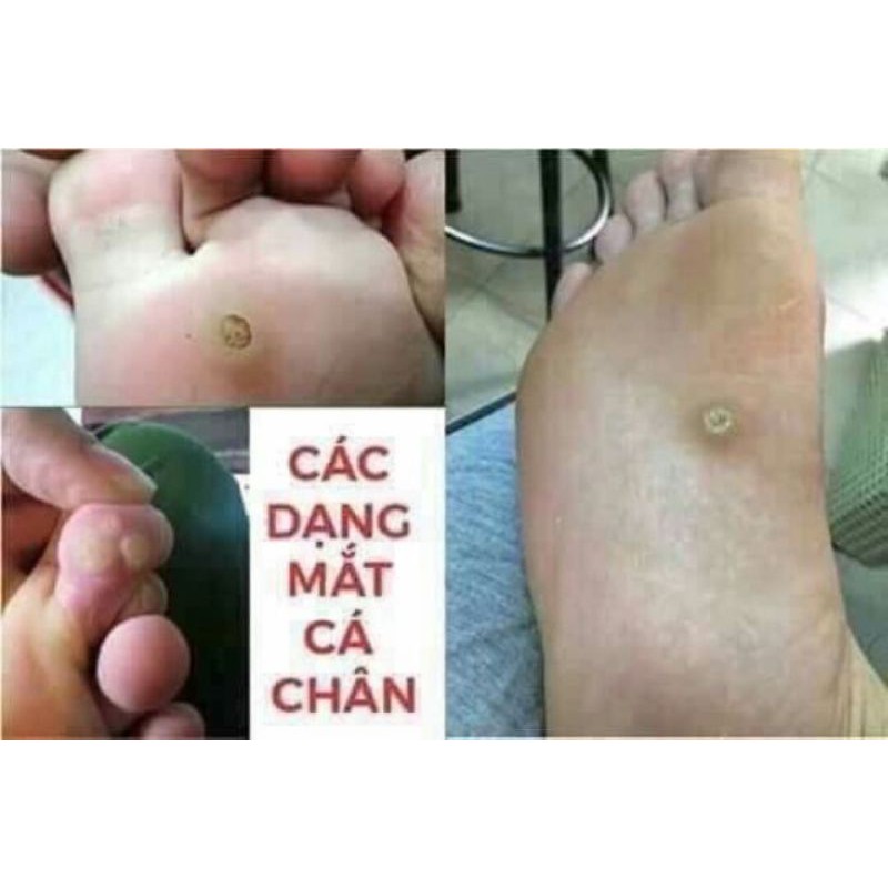 CON CON Chuyên Loại Bỏ Mụn Cóc