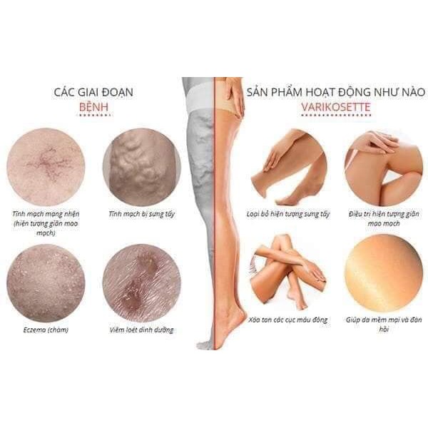 Kem Trị Suy Giãn Tĩnh Mạch Varikosette của Nga