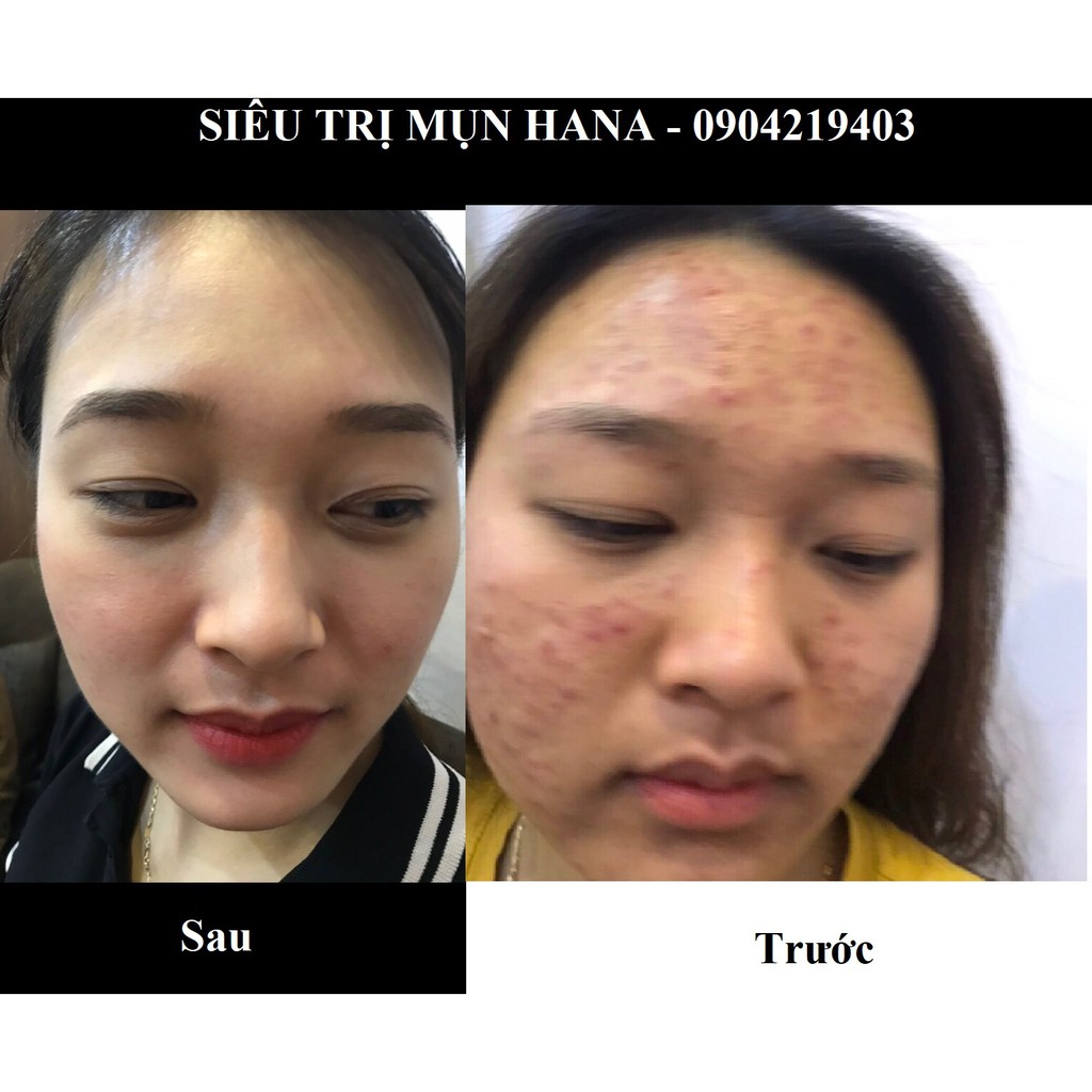 Serum giảm mụn thâm rỗ  Hana- Hiệu quả sau 1 tuần sử dụng (Đã được chứng minh tại rất nhiều Spa và nhà thuốc lớn)