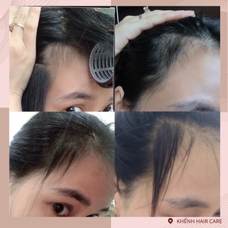 COMBO HỖ TRỢ MỌC TÓC, HỖ TRỢ GIẢM RỤNG