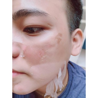 [Chính Hãng] Peel da TCA thay da sinh học mụn, rỗ, thâm, nám, lỗ chân lông to, da dầu, rạn, sẹo lồi, làm trắng mịn da