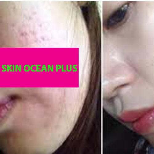 KEM TRỊ MỤN SKIN OCEAN PLUS - TRỊ MỤN TẬN GỐC , HIỆU QUẢ 99% -  NGĂN NGỪA TÁI PHÁT | BigBuy360 - bigbuy360.vn