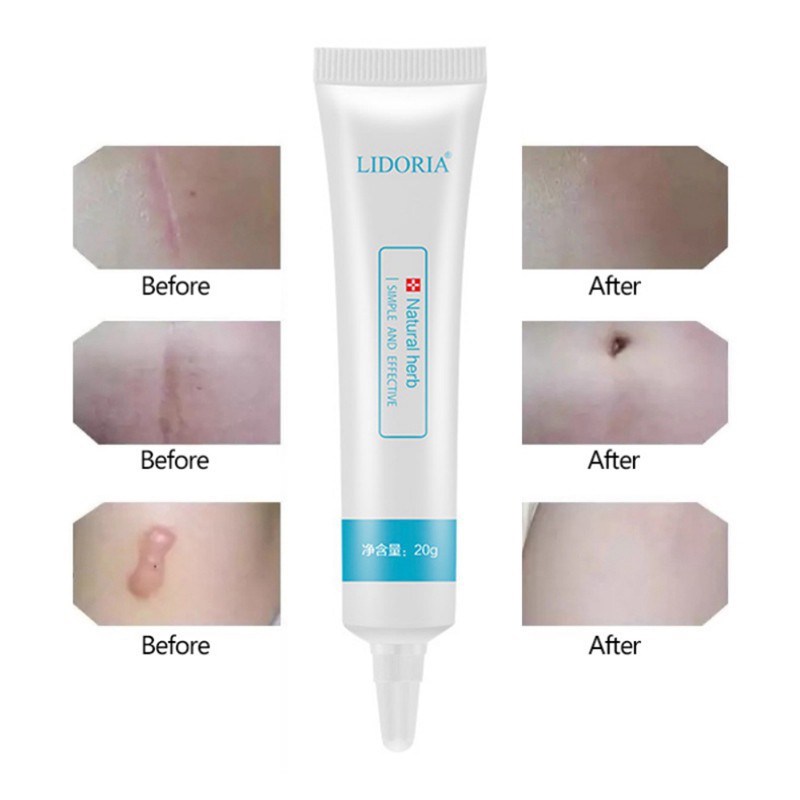 [Hàng mới về] Kem chăm sóc da mặt LIDUOLIYA 20g hydrat hóa loại bỏ sẹo mụn cho da mịn màng | BigBuy360 - bigbuy360.vn