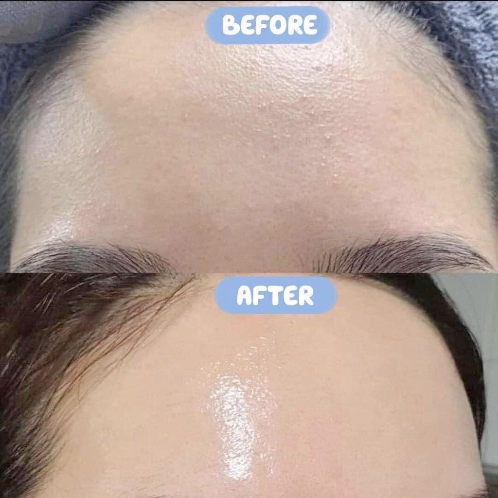 Serum Smas HA Plus chuyên cấp ẩm và phục hồi da