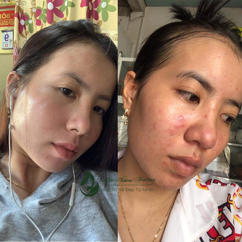 Serum giảm mụn thâm rỗ, sáng da, se khít lỗ chân lông Mộc Thiên Hương | BigBuy360 - bigbuy360.vn