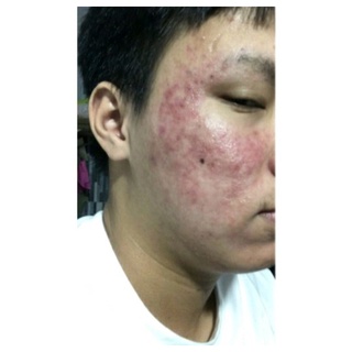 SERUM THẢO DƯỢC NHÂN SÂM SẠCH MỤN MAY NEW 50ML
