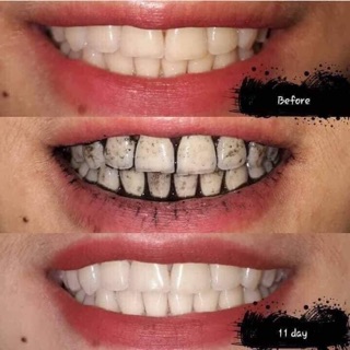 Bột Trắng Răng Than Hoạt Tính My Smile