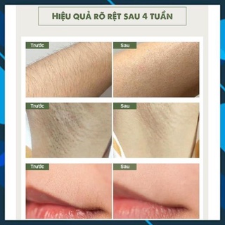 Máy Triệt Lông Cầm Tay  Cao Cấp