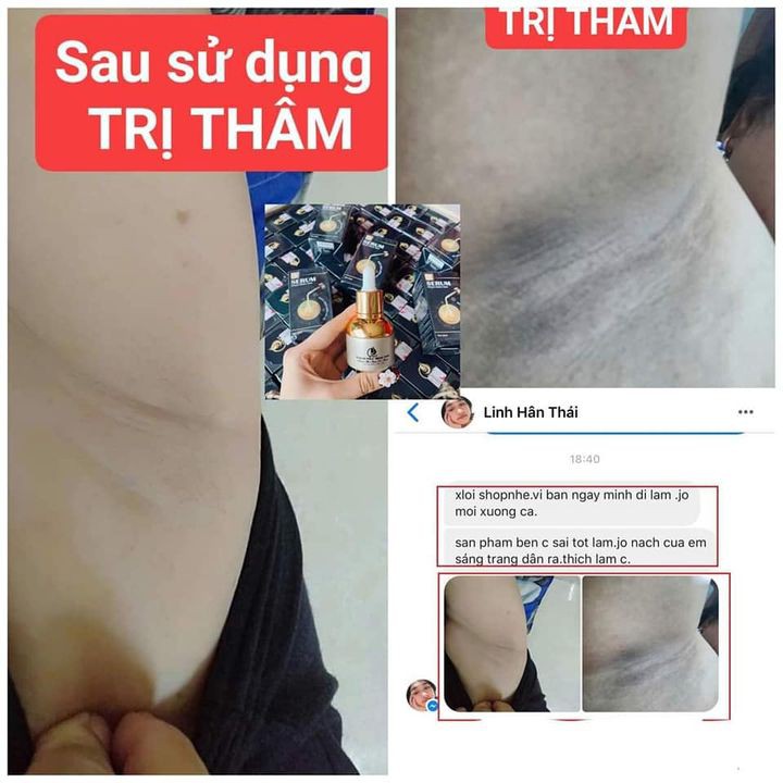 Tinh chất Serum giảm ngừa thâm nách,chân tay PMT