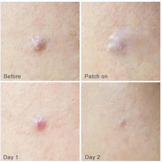 Miếng dán mụn Careplus Olive Young Oliveyoung 102 miếng