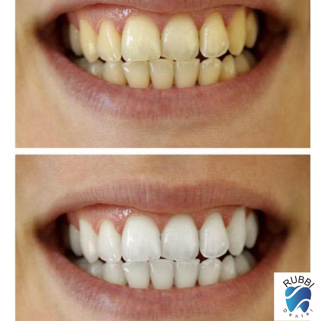 Miếng dán trắng răng 3D,5D white teeth whitening trắng răng bật tông trong 7 ngày sử dụng