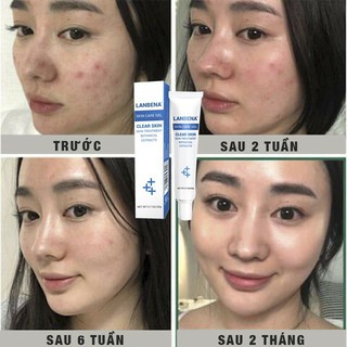 Kem trị mụn - gel thảo dược lanbena