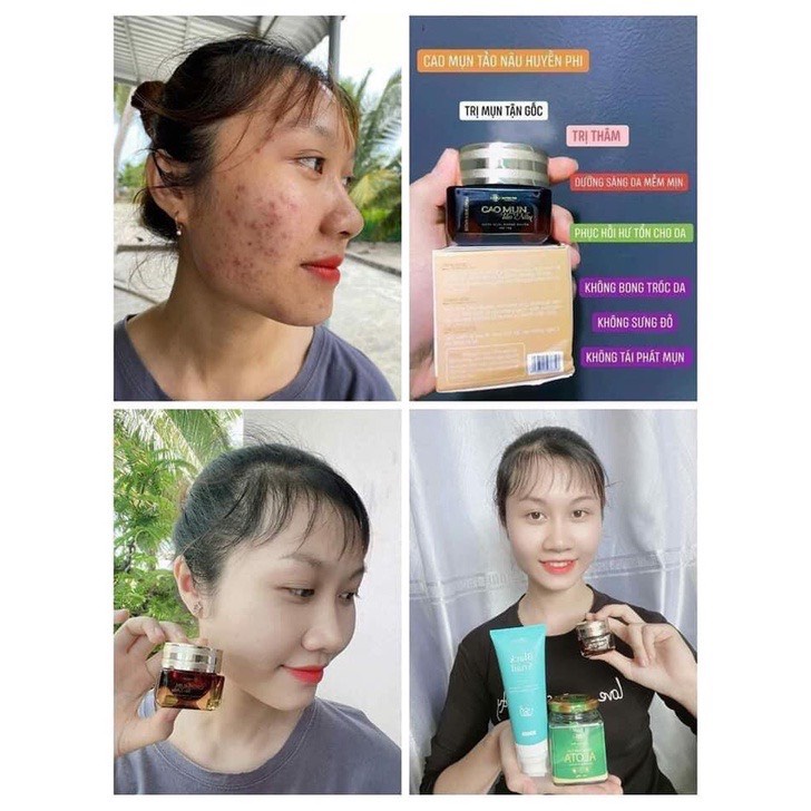 Cao mụn tảo nâu, cao mụn tảo nâu Huyền Phi công dụng tiêu mụn giảm thâm ngừa sẹo 100% thiên nhiên MINOXI | BigBuy360 - bigbuy360.vn