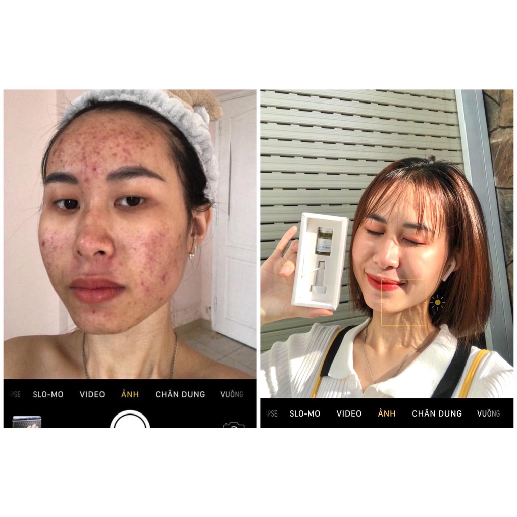 Serum giảm mụn HANEVA, tinh chất ngừa, đánh bay mụn, sạch thâm, dưỡng trắng da hiệu quả chỉ sau 7 ngày