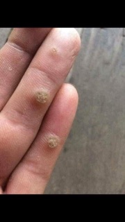 Tẩy mụn ruồi Nga