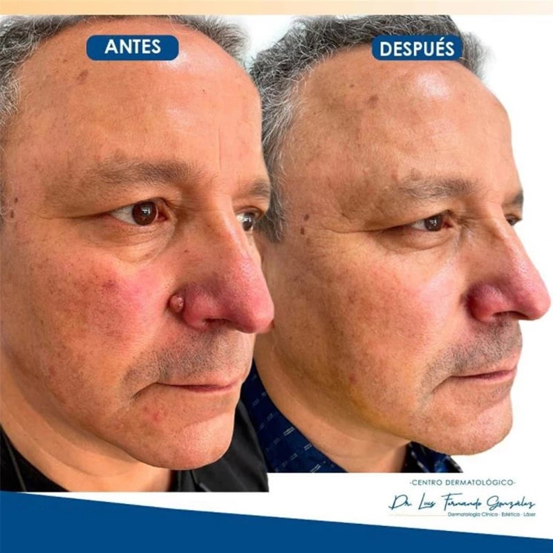 Serum Hỗ Trợ Giảm Mụn Cóc Nốt Ruồi Không Đau Hiệu Quả
