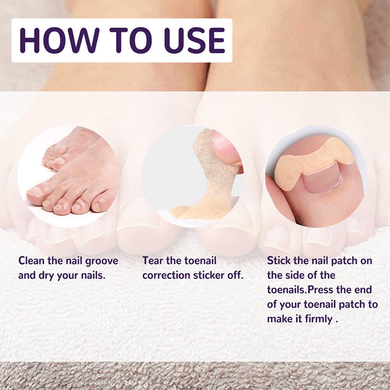 Set 50 Miếng Dán Điều Chỉnh Móng Chân Mọc Ngược