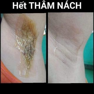 TRIỆT LÔNG NÁCH AN LÀNH