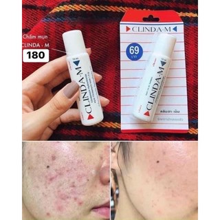 Serum chấm mụn Clinda M 15ml