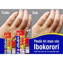 Dung dịch thoa hết mụn cóc của nhật