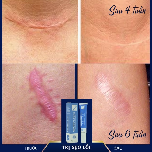 Cách lấp đầy sẹo lõm tại nhà, Scarie'l Forte 10g của EUNICE