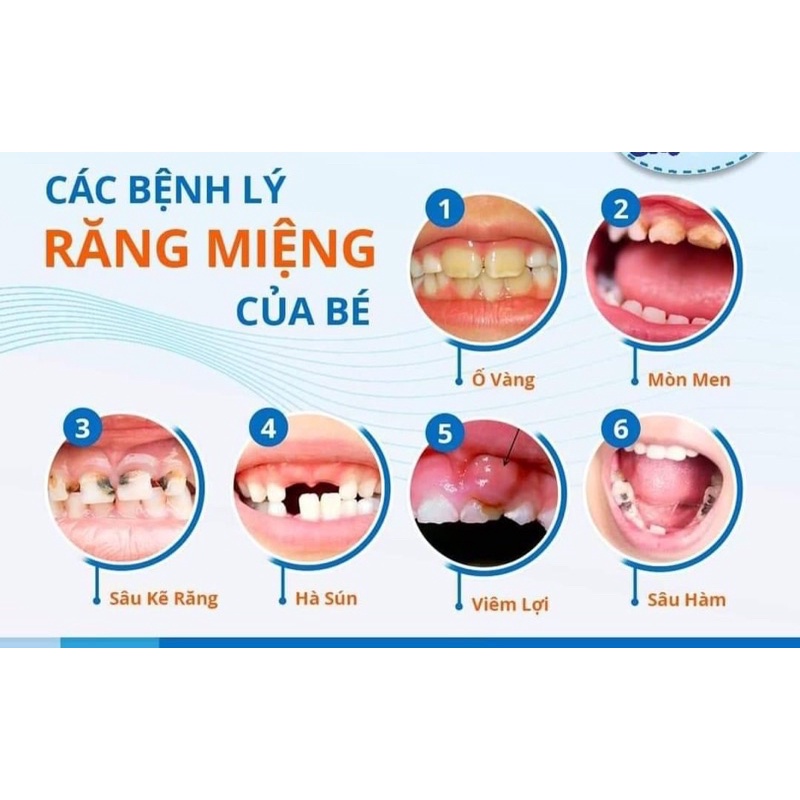 Xịt chống sâu răng Vshine chai 30ml