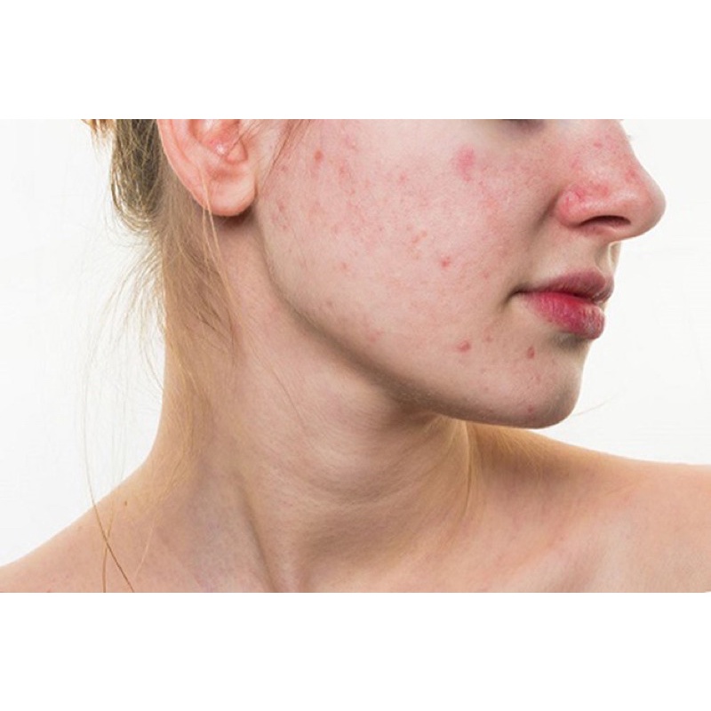 SHISEIDO GEL DƯỠNG ẨM MATCHA CHO DA MỤN PURE&MILD 50ml