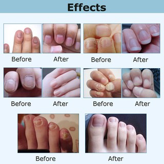 Bút Hỗ Trợ Cải Thiện Bệnh Nấm Móng