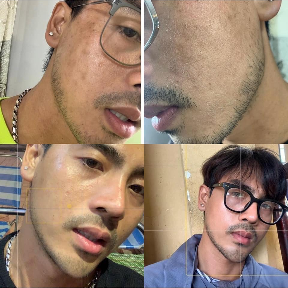 Peel da vi tảo Lepeau sạch mụn thâm sẹo rỗ, hàng công ty phân phối chính hãng giá sỉ - dhviet