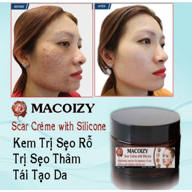 Kem Xóa Sẹo Rỗ MACOIZY Dưỡng Trắng Hết Thâm