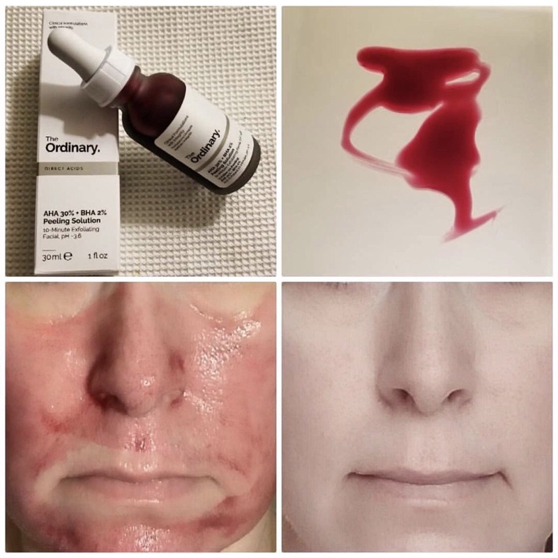 Tẩy Da Chết Hoá Học làm sáng mịn da The Ordinary AHA 30% + BHA 2% Peeling Solution