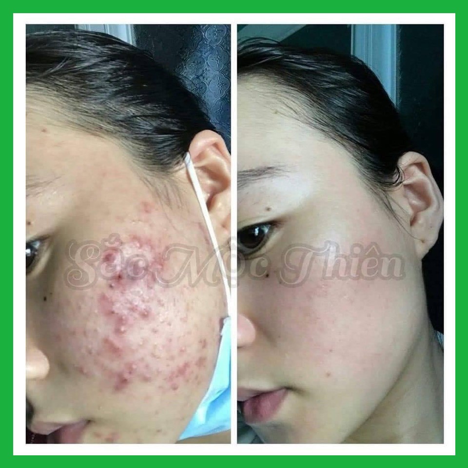 Serum Tinh Chất Tái Tạo Cao Cấp Mua Kèm Quà Tặng Sắc Mộc Thiên - Cải Thiện Mụn Thâm - Sẹo Rỗ - Nám Tàn Nhang