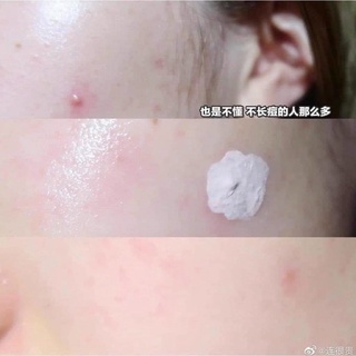 sản phẩm chấm mụn viên