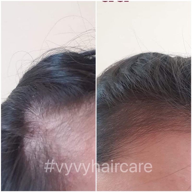 Combo dưỡng kích mọc phủ bóng tóc VyvyHairCare