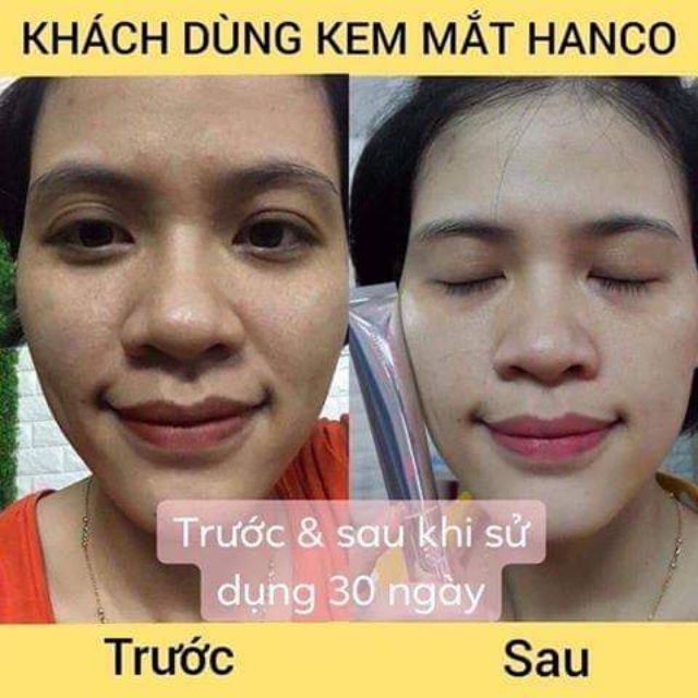 KEM MẮT  TÍCH HỢP MÁY MASSA TRỊ THÂM QUẦNG, BỌNG MẮT, CHÂN CHIM